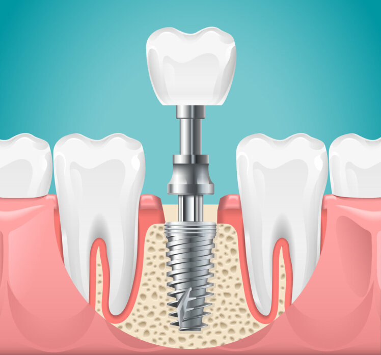 پروتز دندان یا ایمپلنت کدام یک برای شما مناسب است؟