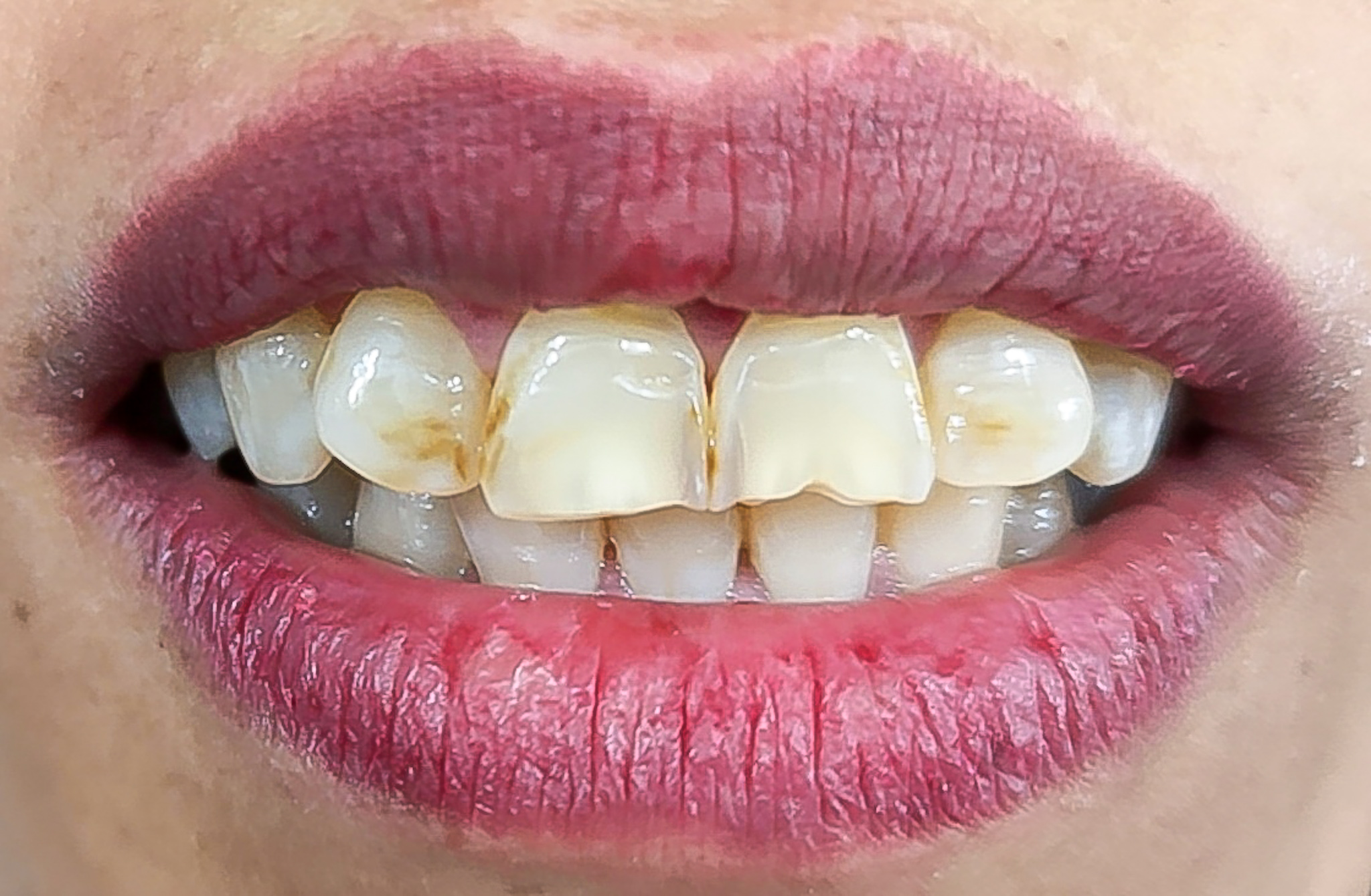 dental tooth دندان دندانپزشکی فک لمینت 