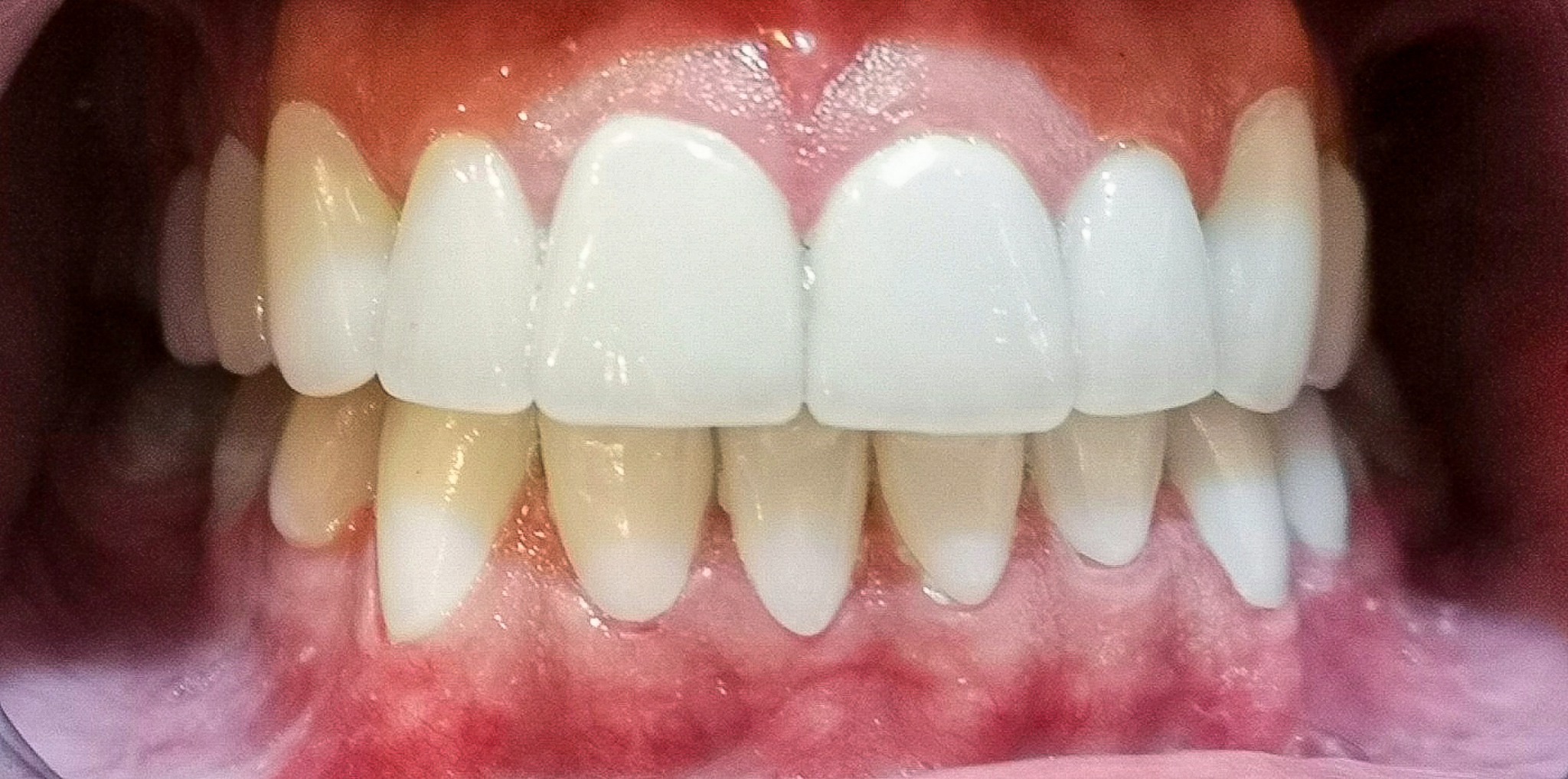 dental tooth دندان دندانپزشکی فک لمینت 